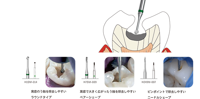 エナメル質う蝕用 MIダイヤモンドバー FG / 総合歯科材料商社