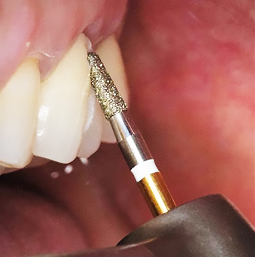 ジルコニア撤去用 4zrsダイヤ 総合歯科材料商社 株式会社モモセ歯科商会