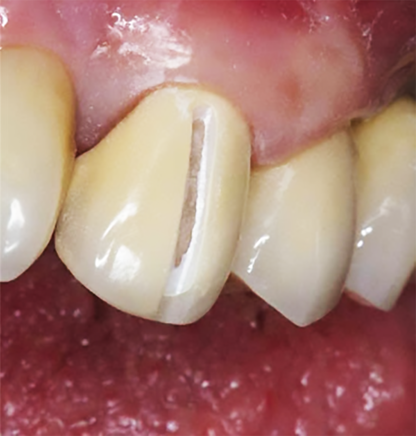 ジルコニア撤去用 4zrsダイヤ 総合歯科材料商社 株式会社モモセ歯科商会