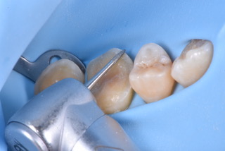 Biomimetic Restorations Kit / 総合歯科材料商社 株式会社モモセ歯科商会